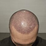 9 days post op how does it look v0 cohn2moo9flc1