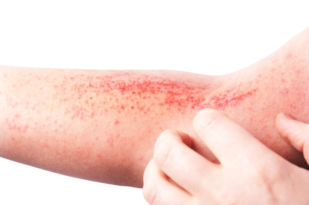 How a Dermatologist Treats Stubborn Eczema 2 Best Dermatologist in Dubai 16