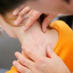 How a Dermatologist Treats Stubborn Eczema 21 Best Dermatologist in Dubai 17