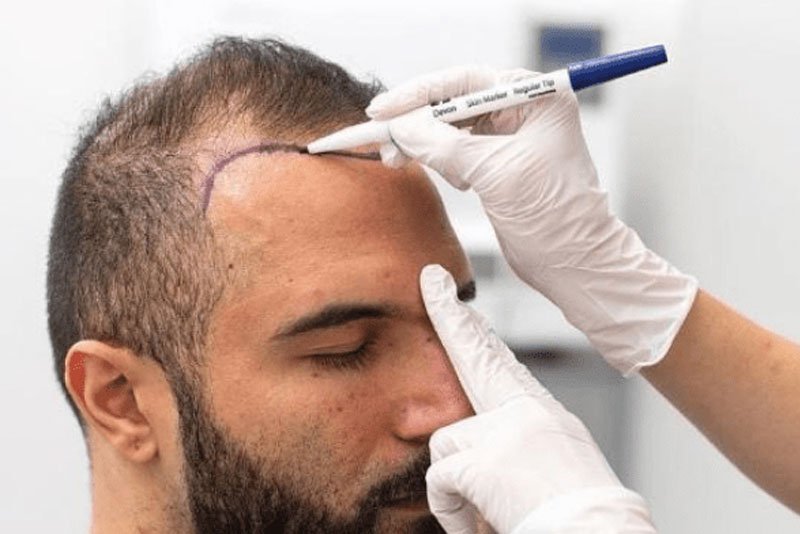 Why Hair Transplants Are the Best Long-Term Solution for Hair Loss 2 Hair Transplant min
