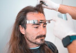 Hair Transplantation 1