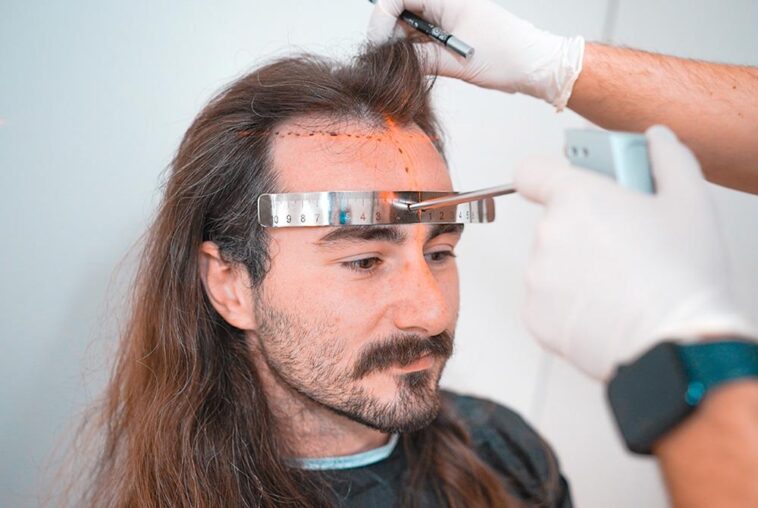 Hair Transplantation 1