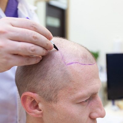 How to Find the Best Hair Specialist for Hair Loss 2 How to Find the Best Hair Specialist for Hair Loss