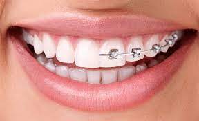 How to Clean and Care for Metal Braces Properly? 1 Metal braces offer unbeatable strength and results