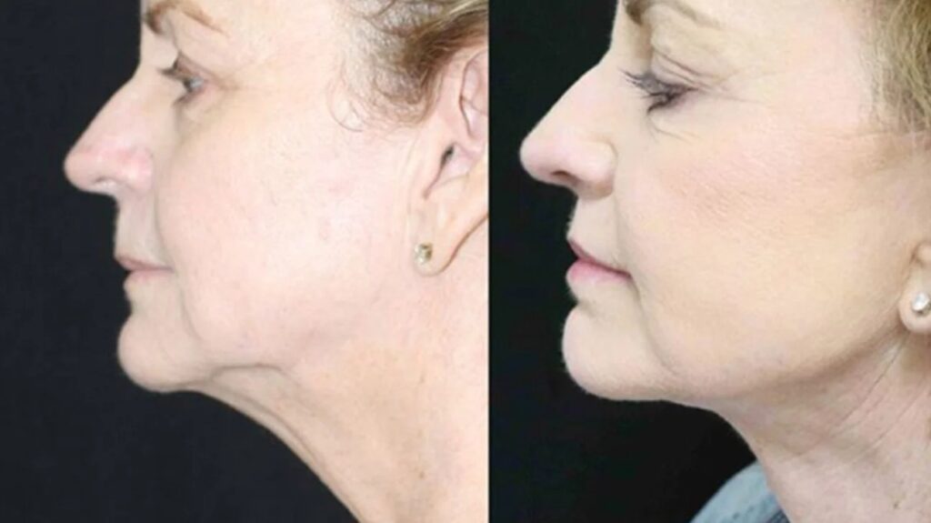 Double Chin Liposuction Procedure 2 Neck lift 1296x728 gallery slide1