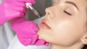 Painless lip filler