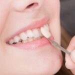 Composite veneers smooth natural and durable results