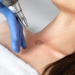Is Laser Tattoo Removal the Best Option to Clear Your Skin? 21 Laser Tattoo Removal in Dubai 1