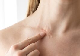 Laser therapy helps fade scars and even skin tone