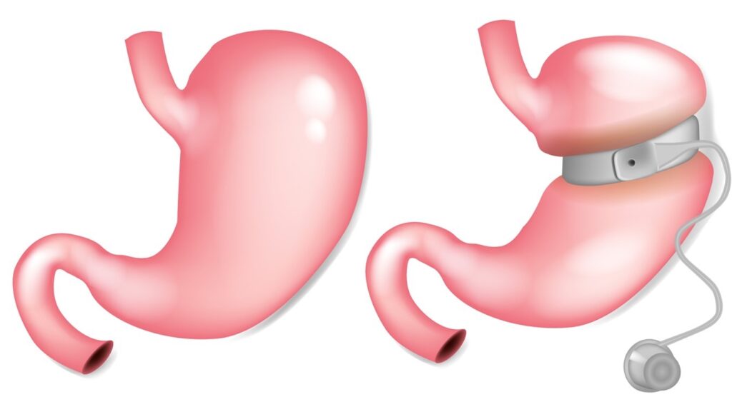 Gastric Balloon Placement for Wellness 2 Picture3BS 0