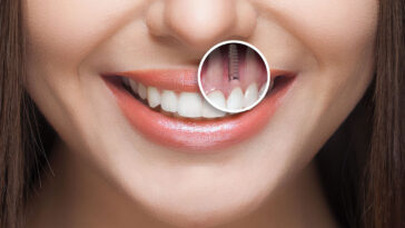 hd cm1401 anterior implant placement