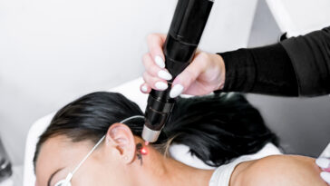 Laser Tattoo removal 8