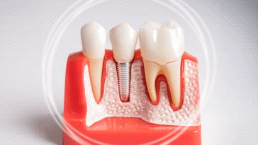 Same Day Teeth Implants What to Expect and How to Prepare 2