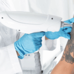 Tattoo Removal 3 1024x569 1