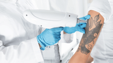 Tattoo Removal 3 1024x569 1