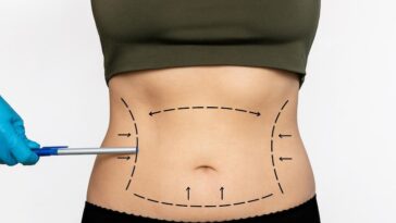 woman s lined belly with excess fat doctor s gloved hand pointing marking stomach with pen 407348 1583