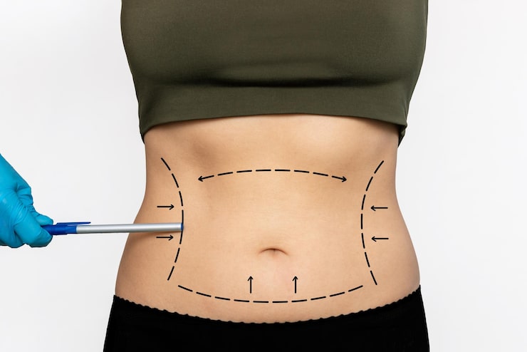 woman s lined belly with excess fat doctor s gloved hand pointing marking stomach with pen 407348 1583